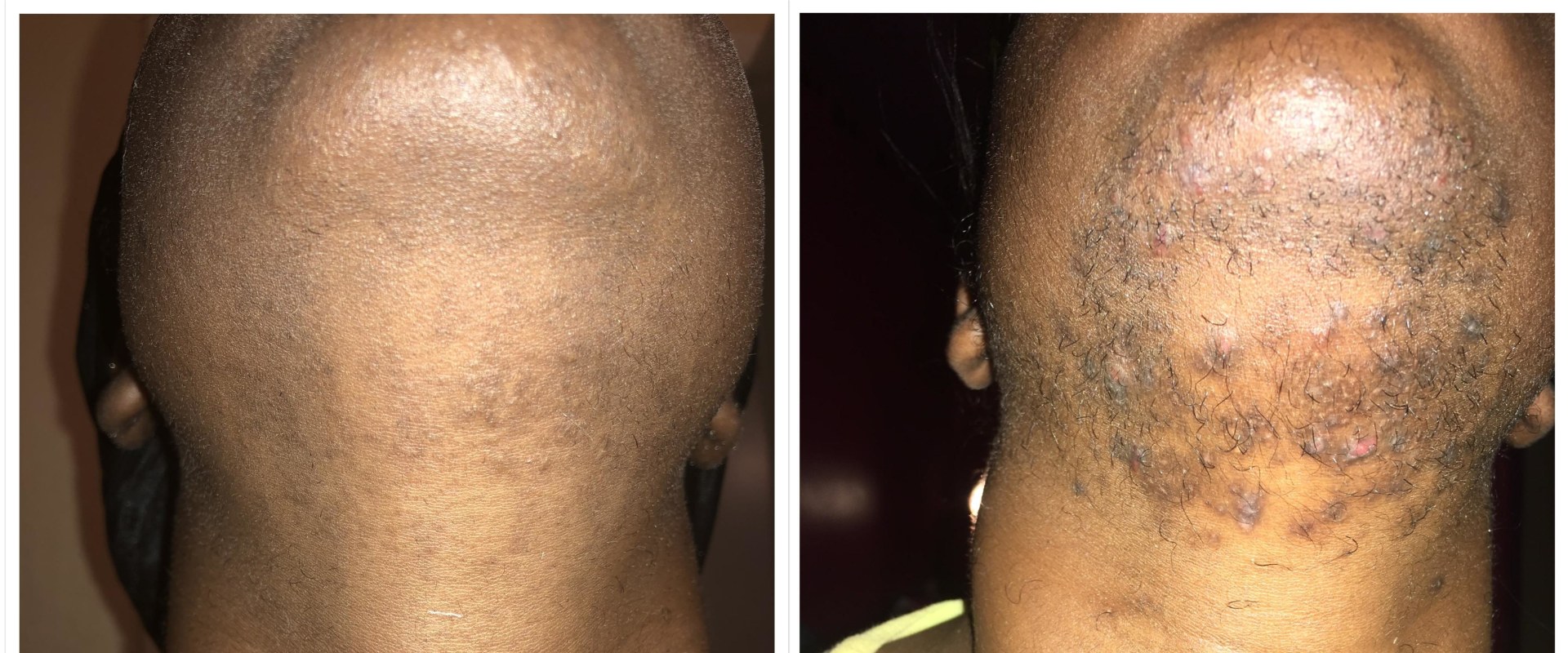 Does Laser Hair Removal Really Last Forever?