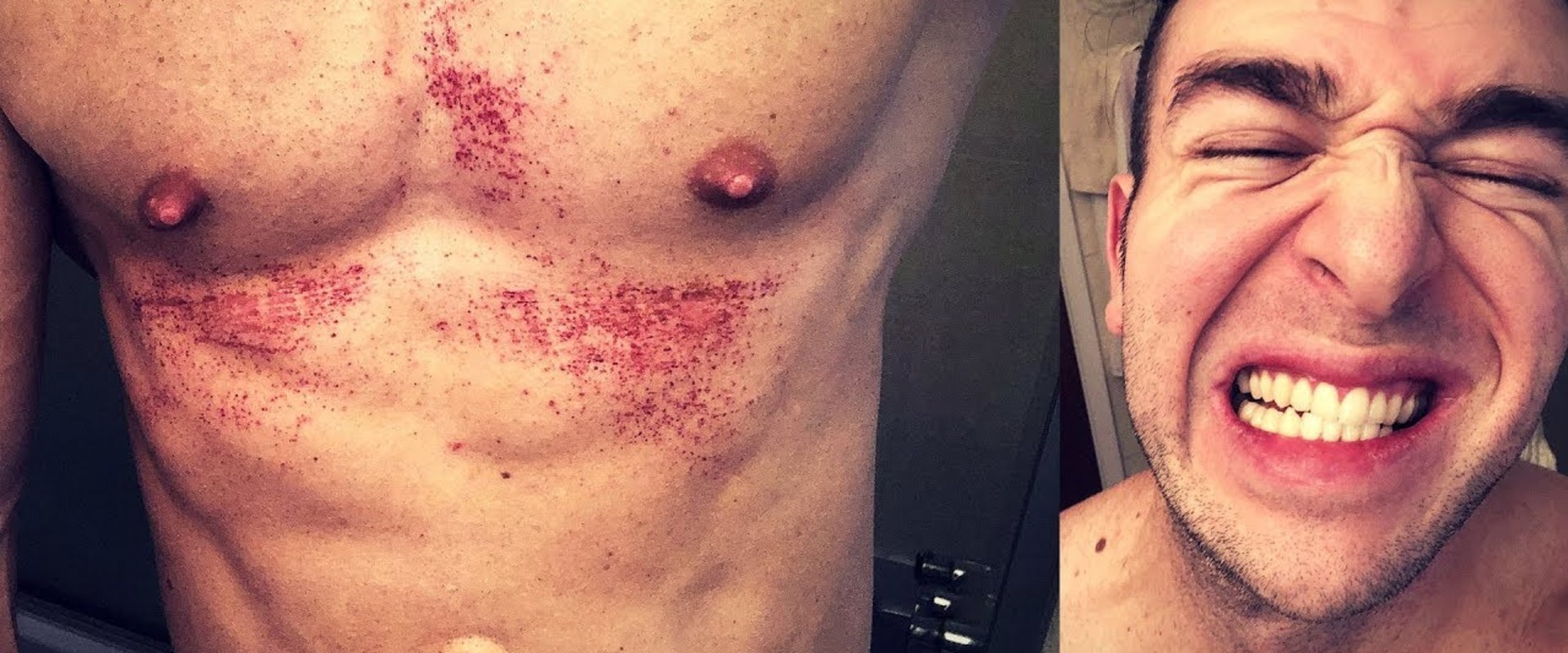 What Are the Risks of Using Nair Before Laser Hair Removal?