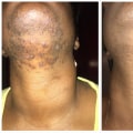 Does Laser Hair Removal Really Last Forever?