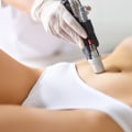 What is the Recovery Time After a Laser Hair Removal Treatment?