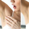 Does Laser Hair Removal Remove It Forever? - An Expert's Perspective