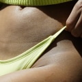 Sunscreen Before or After Laser Hair Removal: What You Need to Know