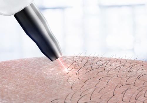 Can I Take Vitamin D Before Laser Hair Removal? - A Guide to Pre- and Post-Treatment Precautions