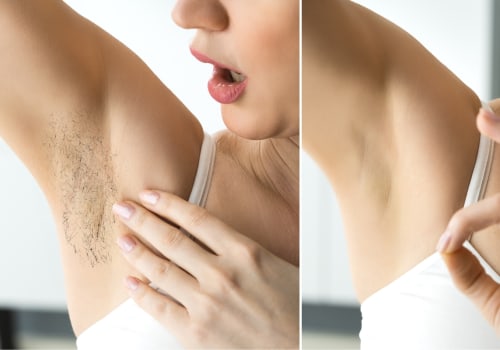 Does Laser Hair Removal Remove It Forever? - An Expert's Perspective